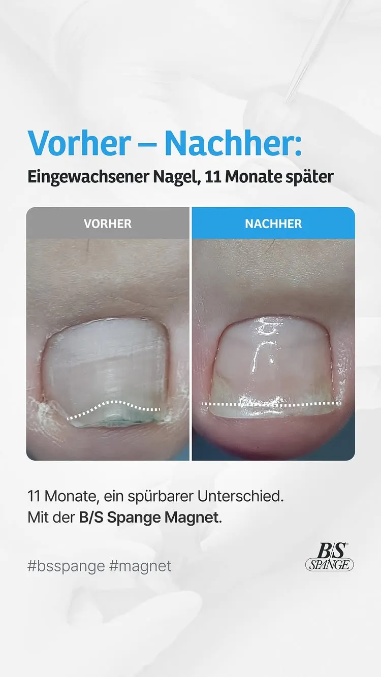 B/S Spange – Original Nagelkorrekturspange seit 1987 | Bernd Stolz